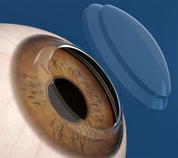 El Hospital San Cecilio implanta la primera córnea artificial en un paciente con una patología grave del ojo