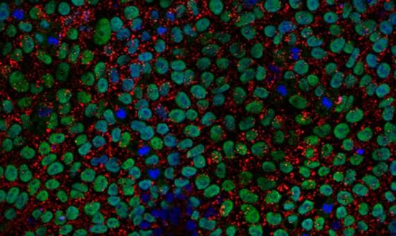Developing a cellular model of familial Meniere's disease