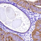 Localizan un microARN que impulsa la aparición del cáncer y la metástasis