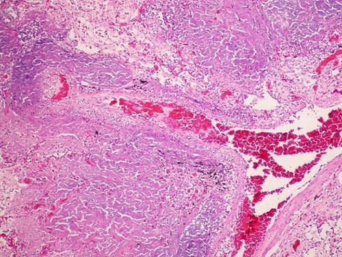 Es desarrollada una nueva vacuna contra la tuberculosis