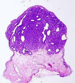 El tiempo entre tratamientos condiciona el pronóstico de supervivencia del cáncer de vejiga