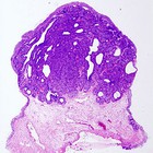 El tiempo entre tratamientos condiciona el pronóstico de supervivencia del cáncer de vejiga