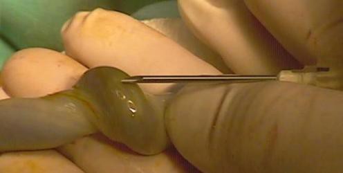 Obtienen huesos artificiales a partir de células madre procedentes de cordón umbilical