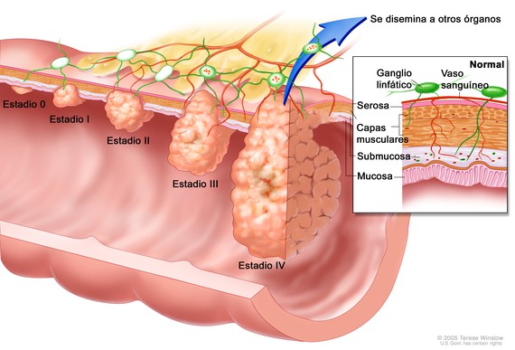 El cribado del cáncer de colon se ‘incoporará’ a la cartera básica de servicios del SNS