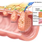 El cribado del cáncer de colon se ‘incoporará’ a la cartera básica de servicios del SNS