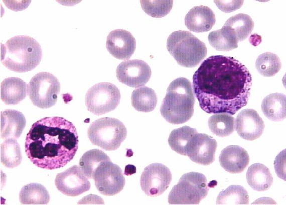 Logran curar leucemia con terapia génica