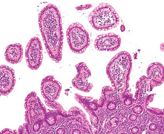 Investigadores del ibs.GRANADA desarrollan una plataforma web para linfomas