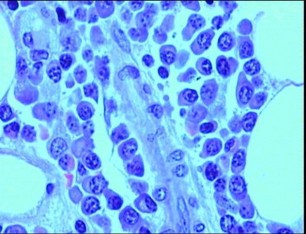 Novedosa investigación sobre el mieloma múltiple