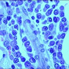 Novedosa investigación sobre el mieloma múltiple