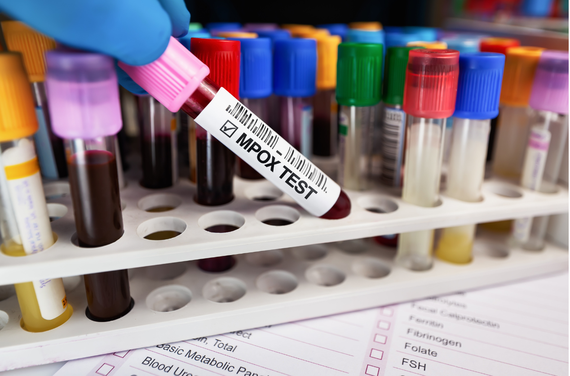 Un estudio del ibs.GRANADA evalúa un ensayo automatizado para la detección del virus de la viruela del mono