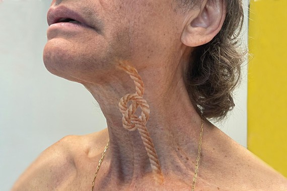 Investigadores del ibs.GRANADA descubren factores clave en la disfagia de supervivientes de cáncer de cabeza y cuello