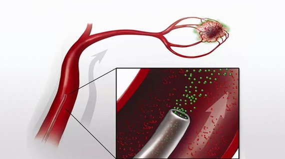 El ibs.GRANADA participa en un estudio multicéntrico para impulsar la radiología intervencionista como tratamiento curativo para el cáncer hepático