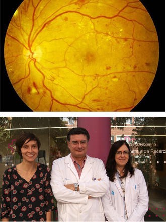 Un ensayo europeo utiliza por primera vez un colirio contra la retinopatía diabética