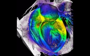 Desarrollan un gel inyectable estimula la regeneración del corazón tras un infarto