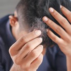 Investigadores del ibs.GRANADA demuestran que padecer alopecia areata se asocia con un tipo de personalidad