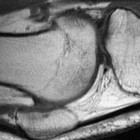 La terapia celular, alternativa terapéutica para la artrosis de rodilla
